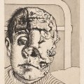 Otto Dix Trasplantado